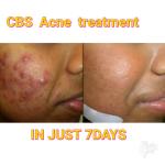 CBS acne treatment