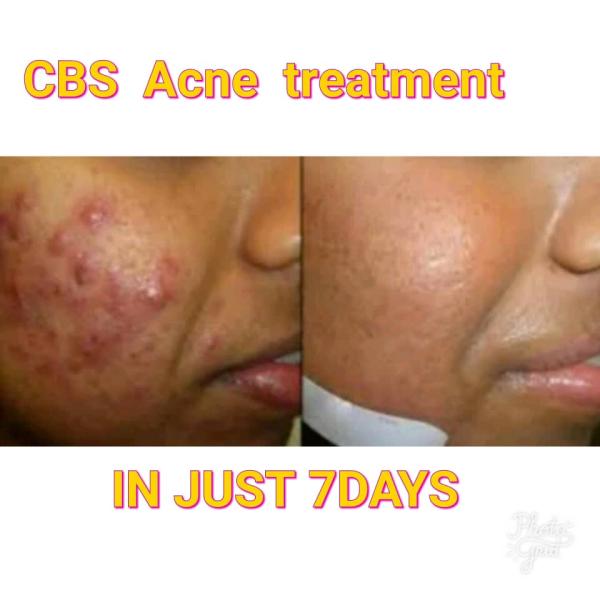 CBS acne treatment